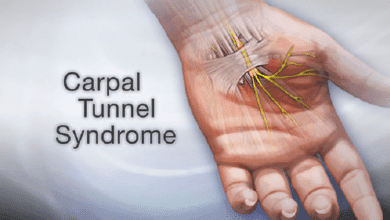 Carpal Tunnel Syndrome ICD 10